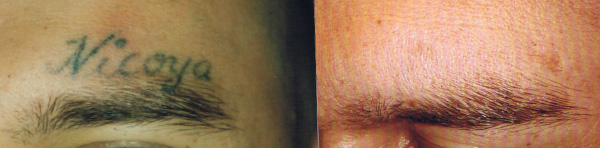 Tattoo Before After Tattoo Before After